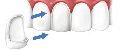 Dental veneers 1