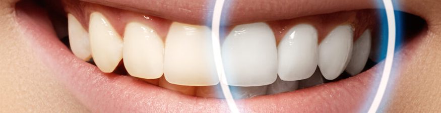 Dental bonding cost in Australia