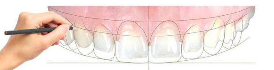Smile Design Dental For This Wedding Season