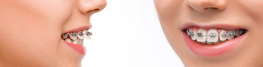 Understanding Overbite and Its Treatment