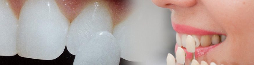 5 Signs You Need Dental Veneers