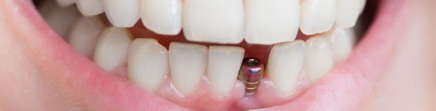 dental implant surgery in the UK
