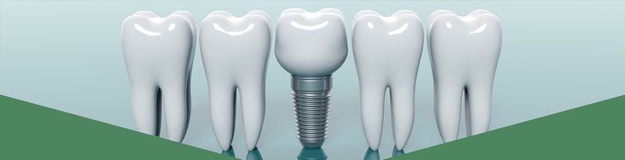 dental implant surgery