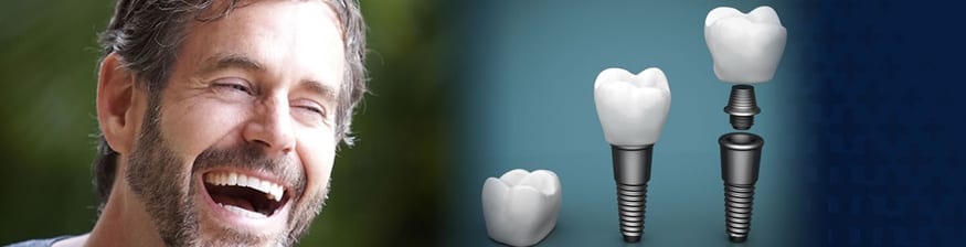 Permanent teeth implants in india