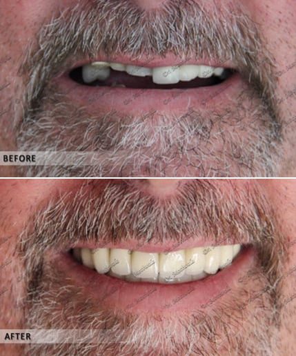 Full Mouth Reconstruction Cost in India