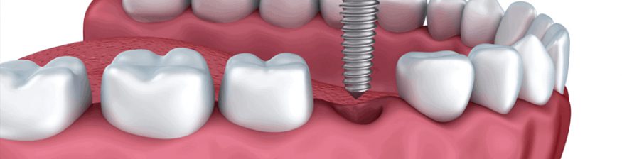 Root Canal vs Implant - Which Is Best?