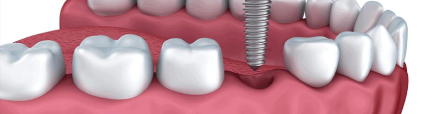 Common Myths About Dental Implants