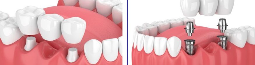 Benefits of dental implants over fixed bridge