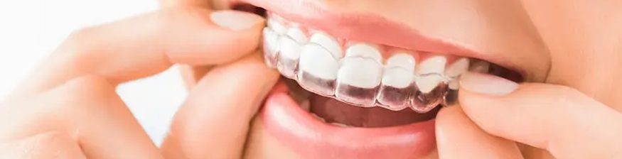 How Does Invisalign Work?