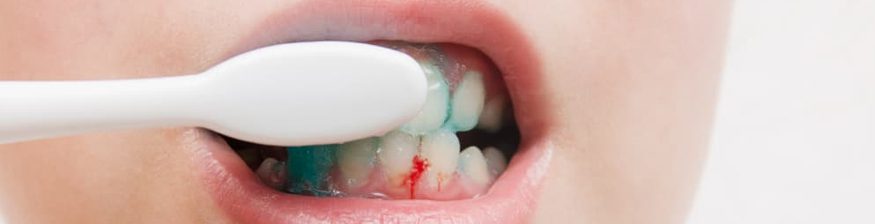 Do This To Avoid Bleeding Gums