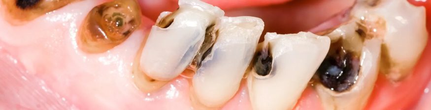 Do Not Panic If You Have Cavities