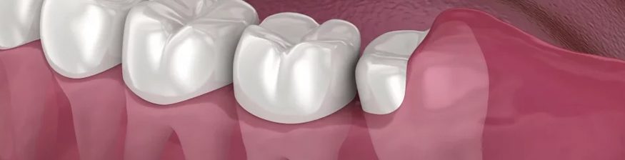 Am I Too Old to Get Wisdom Teeth Extracted?