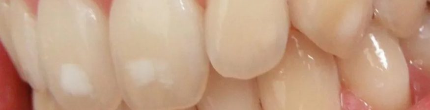 What Are White Spots and How To Get Rid Of Them?