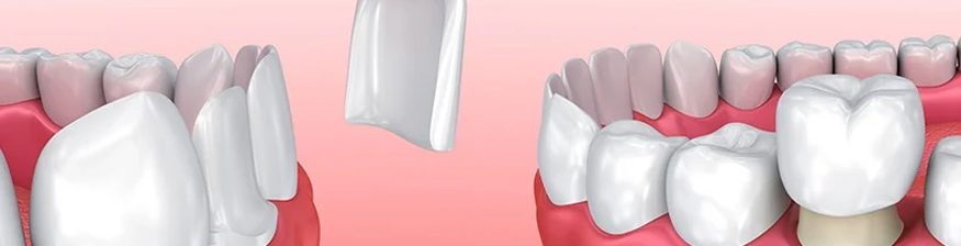 Porcelain Veneers vs. Dental Crowns: What’s Right for You?