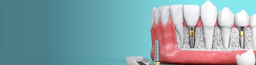 Navigating Implants: Understanding Basal Implant Techniques