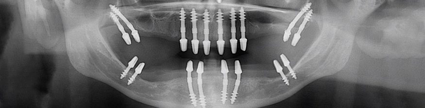 Basal Implants: A Game-Changer for Patients with Low Bone Density