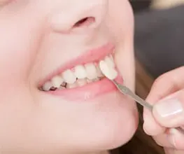 dental-veneers