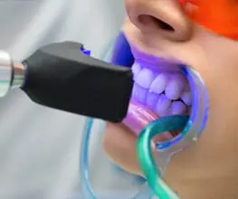 teeth-bleaching