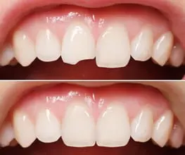 tooth-bonding