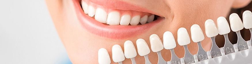 Choose the Right Shade of White for Your Smile Makeover
