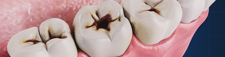 Dental Déjà Vu: Why People Get Cavities in Exact Same Spots