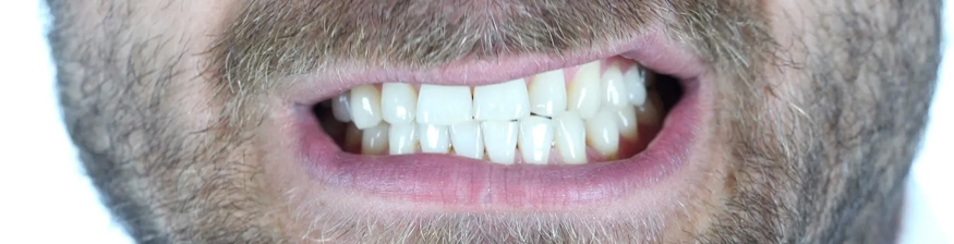 Why Zirconia Crowns Are Go-To for People Who Grind Their Teeth