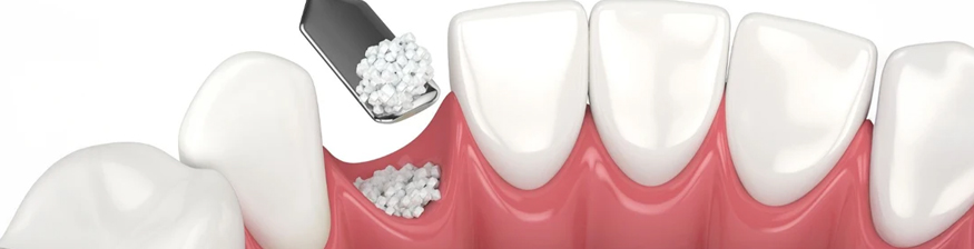 AI Proves Bone Grafts Are Outdated: What Your Dentist Isn't Telling You