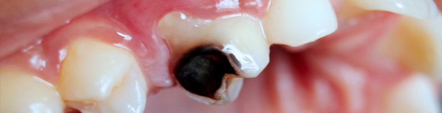 The Cavity Vaccine: Future of Dental Caries Prevention