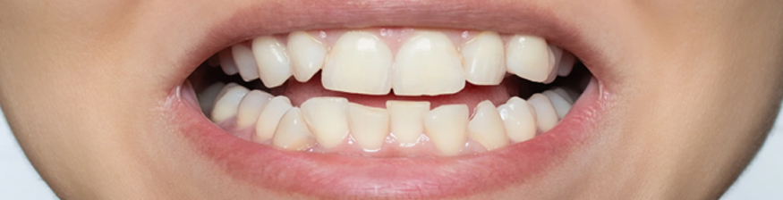 Tooth Memory: Why Your Teeth ‘Remember’ Their Crooked Positions